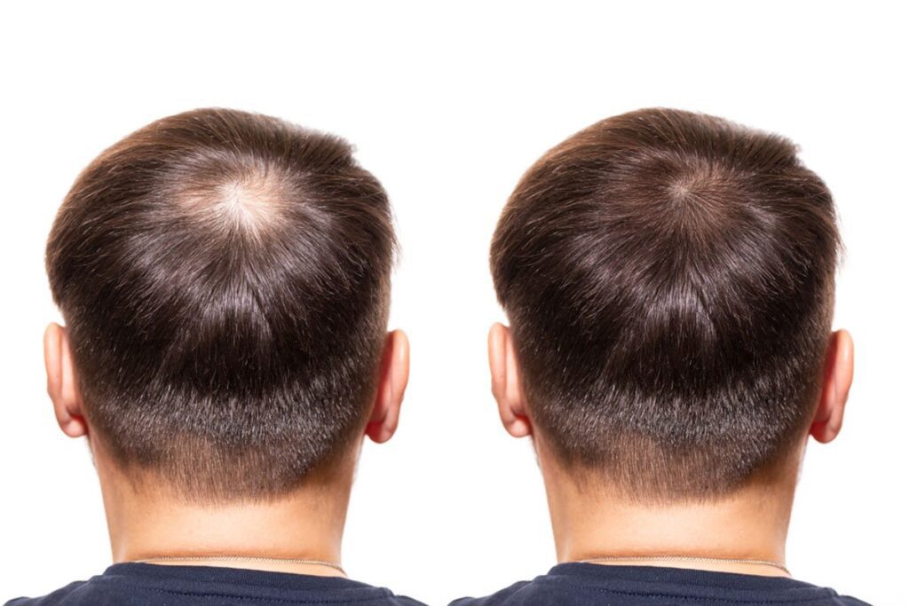 From Hesitation to Hope: The Importance of Hair Transplant Before and After Photos