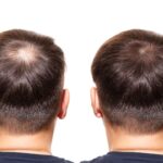 FUE Hair Transplant London: A Patient’s Complete Journey from Initial Consultation to Final Results