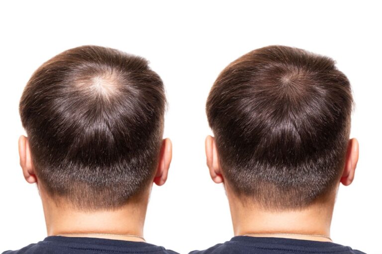 FUE Hair Transplant London: A Patient’s Complete Journey from Initial Consultation to Final Results