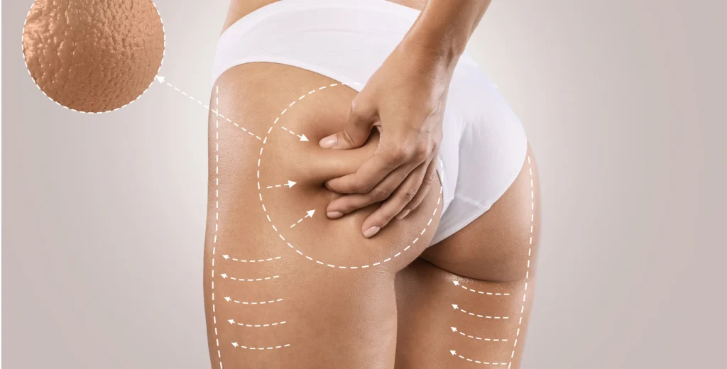 The Ultimate Guide to Securing the Best Cellulite Treatment London Can Provide