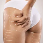 The Ultimate Guide to Securing the Best Cellulite Treatment London Can Provide