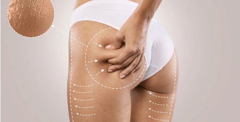 The Ultimate Guide to Securing the Best Cellulite Treatment London Can Provide