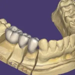 How the Rise of the 3D Lab Is Reshaping Restorative Dentistry