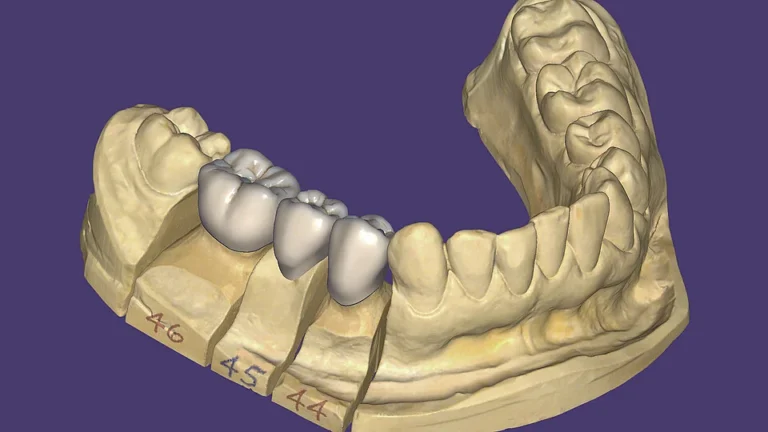 How the Rise of the 3D Lab Is Reshaping Restorative Dentistry